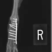 Crete Partial Tarsal Arthrodesis
